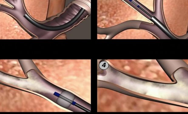 enfisema